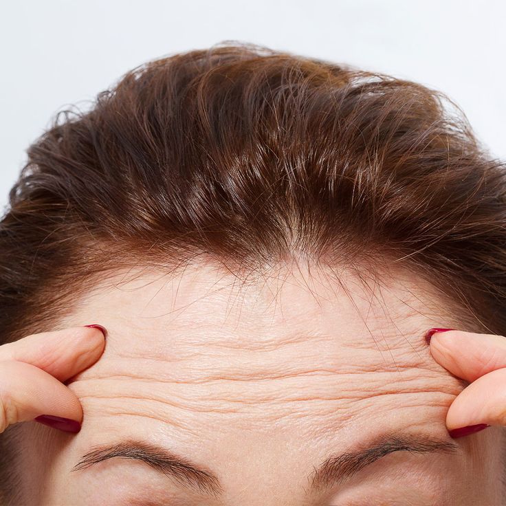 Forehead Lines Consultation