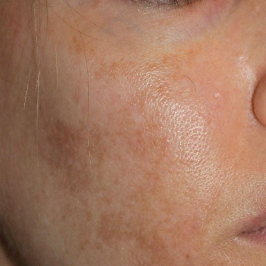 Uneven Skin Tone & Pigmentation Consultation