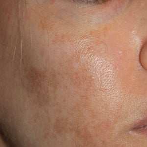 Uneven Skin Tone & Pigmentation Consultation