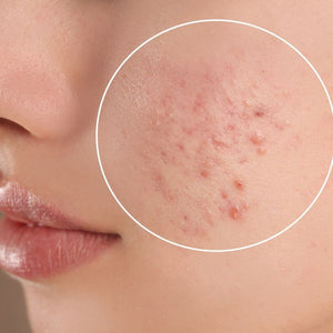Acne & Breakouts Consultation