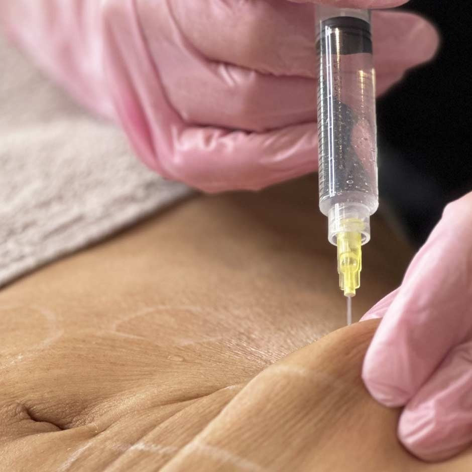 PBSerum Medical HA 2.0 HIGH (1.5 mL + 5 mL)