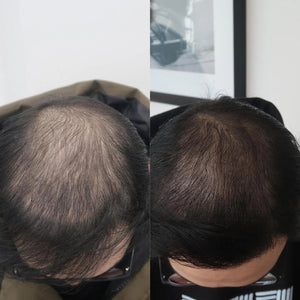 Triple-Action Hair Restoration Therapy