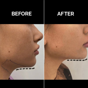 Enzymatic Skin Tightening & Bio-Restructuring Treatment
