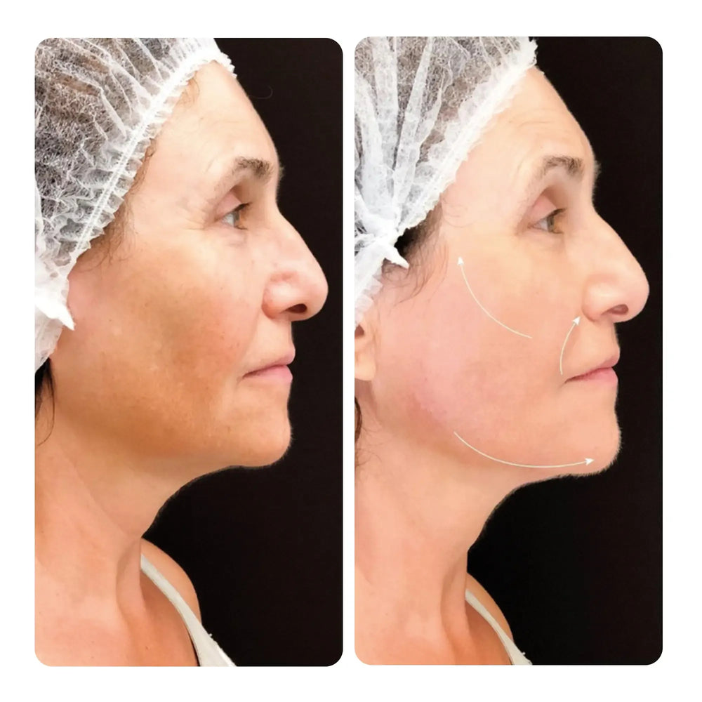 Facetem S 1.5 mL Dermal Filler & Collagen Biostimulator for Non-Surgical Lifting