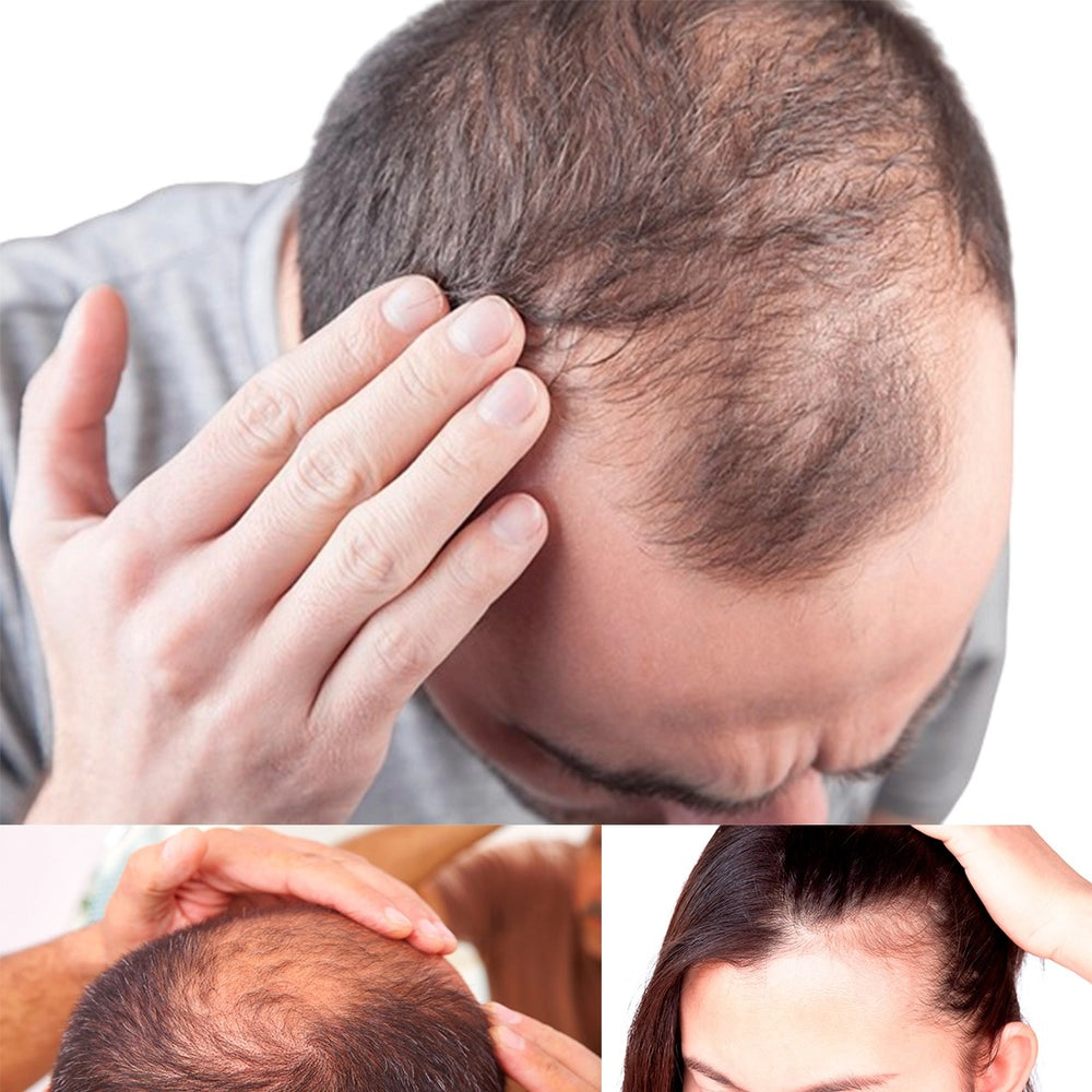 Minoxidil (Meso Mix) 2 mL – Targeted Hair Regrowth & Scalp Revitalisation