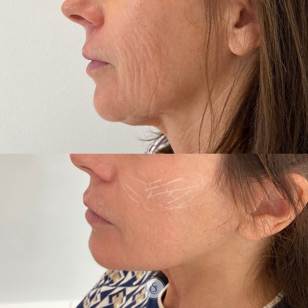 Define and Lift with Radiesse 1.5 mL