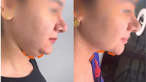 PBSerum Medical HA 2.0 MEDIUM (6 mL) – Advanced Enzyme Therapy for Localized Fat & Double Chin Reduction