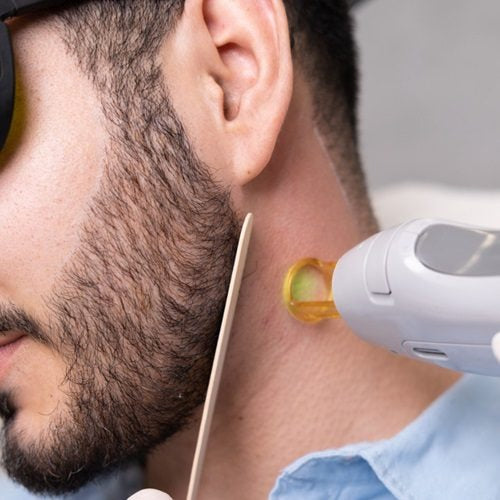 Beard Line Laser Hair Removal