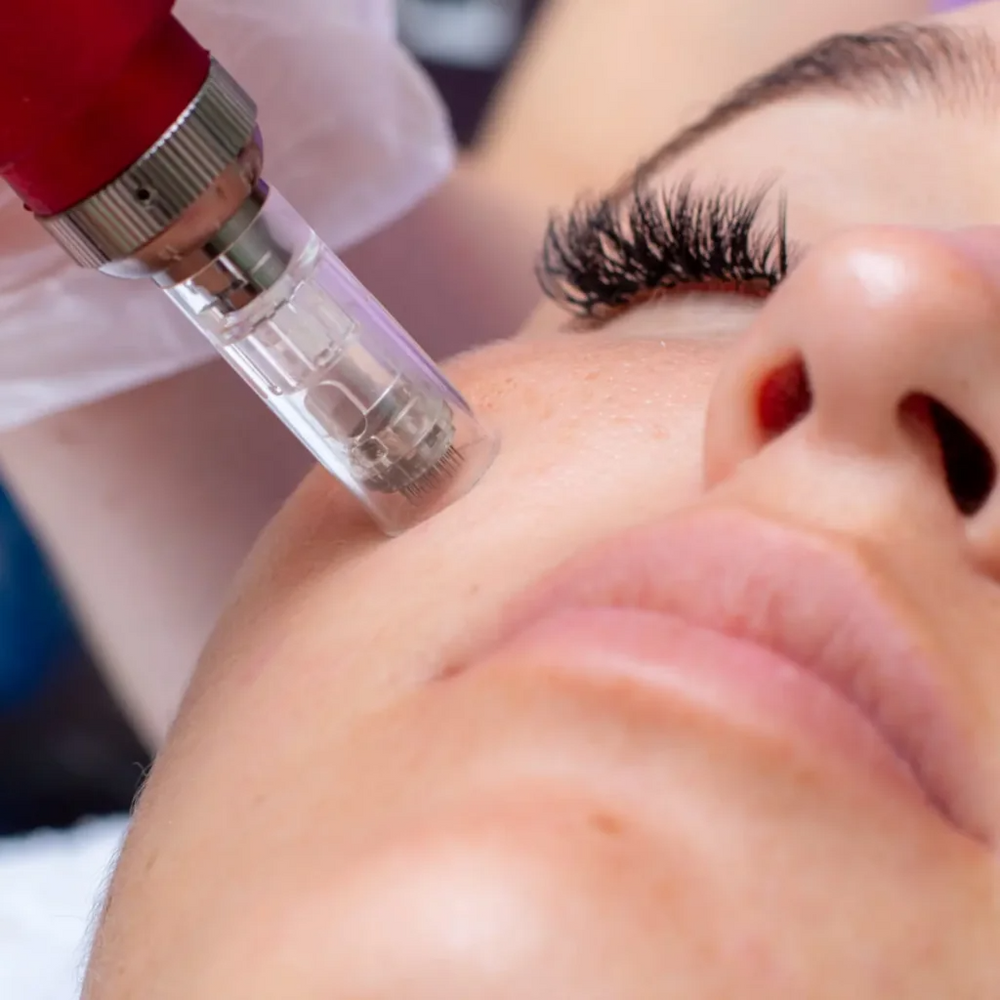 RRS Hyalift 75 PRO (3mL) – High-Concentration Hyaluronic Acid Biorevitalizer & Skin Booster