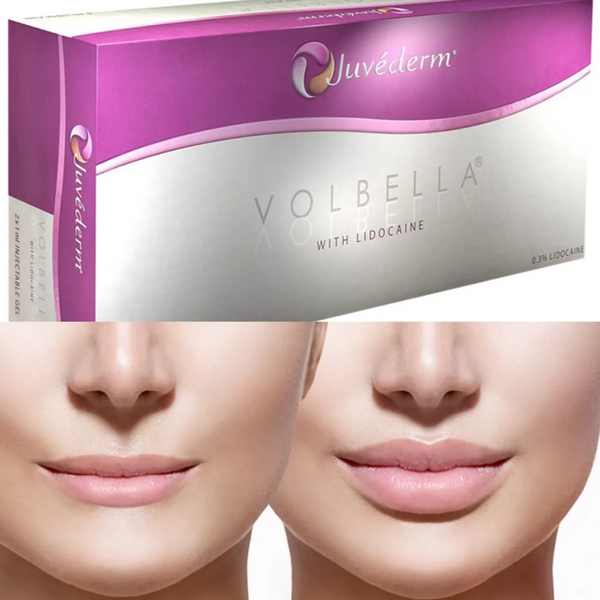 Juvederm Volbella XC 1 mL – Premium Hyaluronic Acid Filler for Lip Augmentation