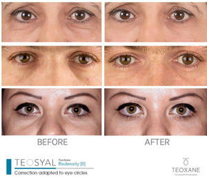 Teosyal PureSense Redensity 2 (1ml) – Advanced Under-Eye & Tear Trough Filler