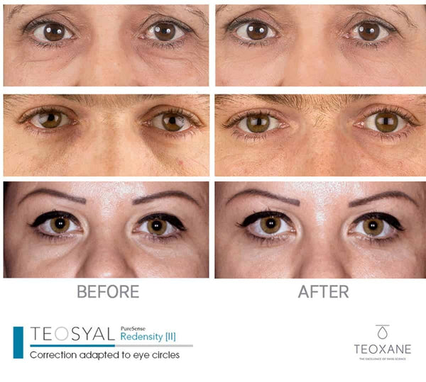 Teosyal PureSense Redensity 2 (1ml) – Advanced Under-Eye & Tear Trough Filler