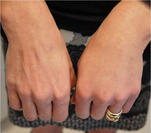 PLABAZ01 PLLA Body Filler (10ml) – Advanced Collagen Stimulator & Volumizer