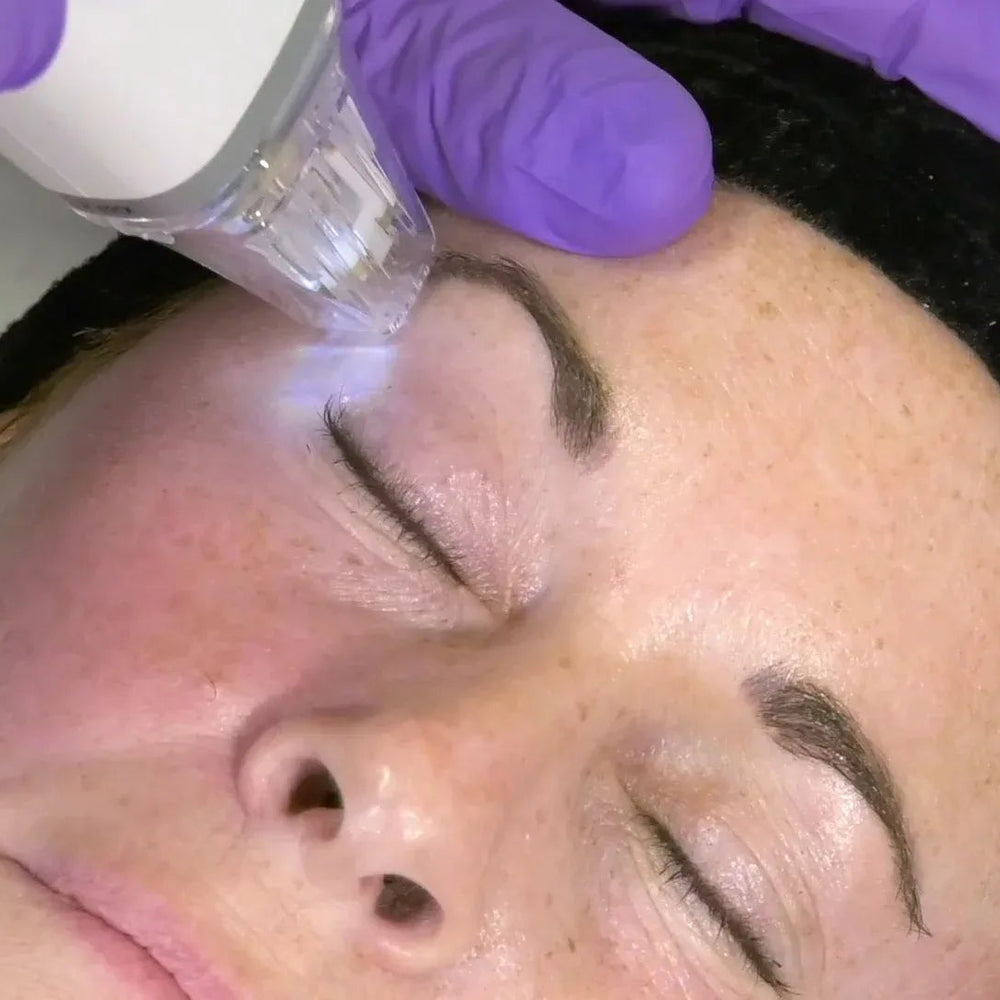 Advanced RF Microneedling for Deep Skin Booster Infusion