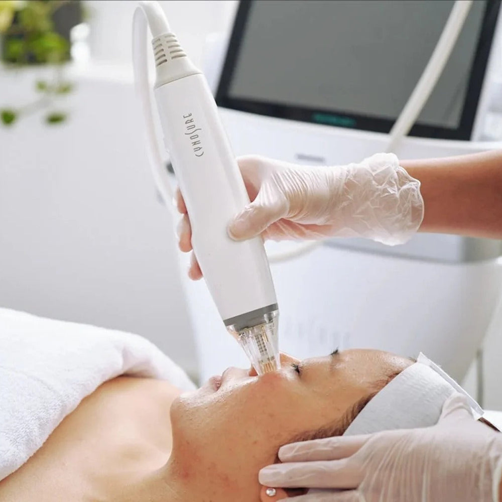 Potenza™ RF Microneedling + Exosome Therapy (1 mL) – Advanced Cellular Skin Repair